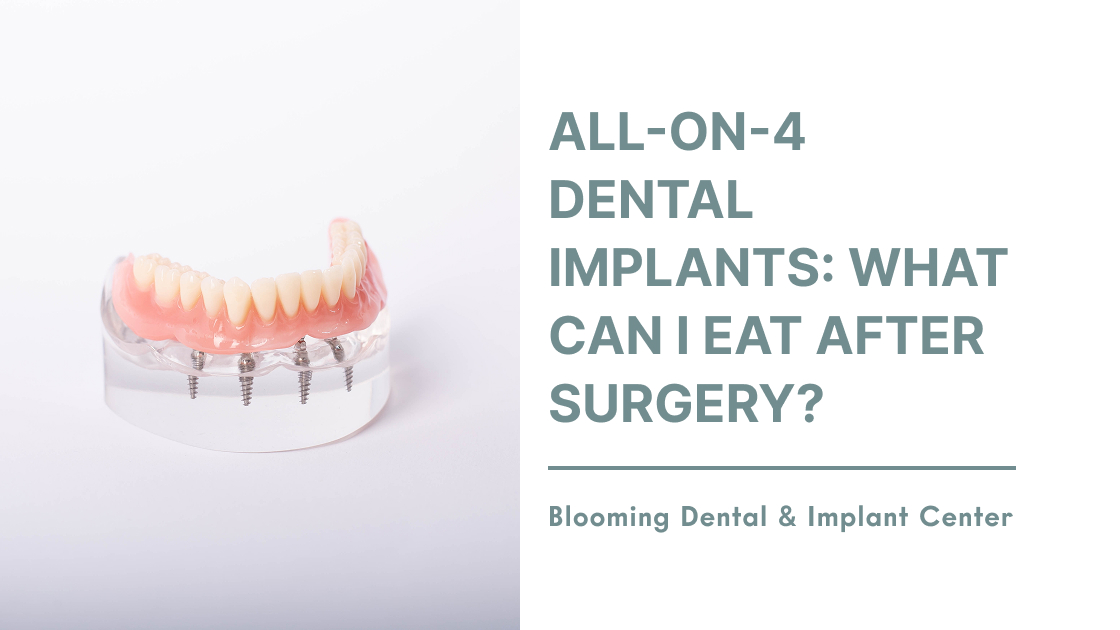 All-On-4 Dental Implants: What Can I Eat After Surgery?