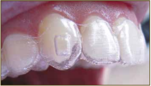 Misfitting Aligner