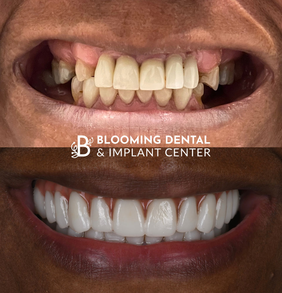 before and after full mouth dental implant