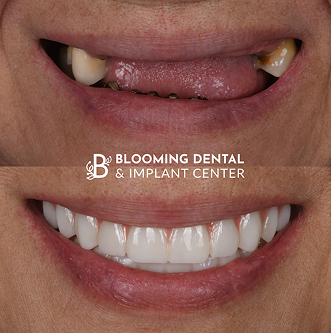 Before-After Image