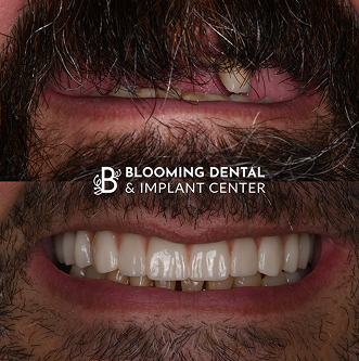 Before-After Image