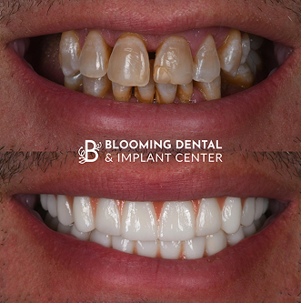 Before-After Image