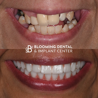 Before-After Image