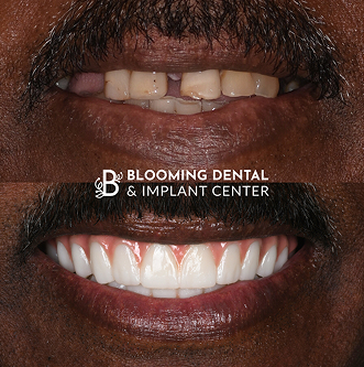 Before-After Image