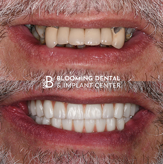 Before-After Image