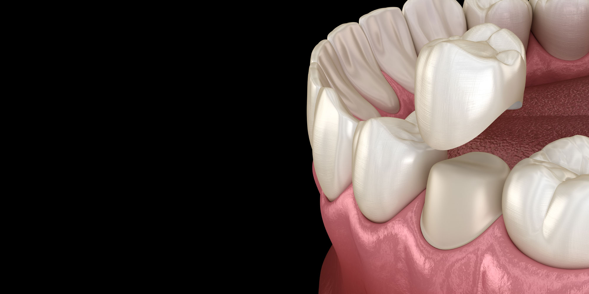 Why Choose CEREC Same-Day Crowns?