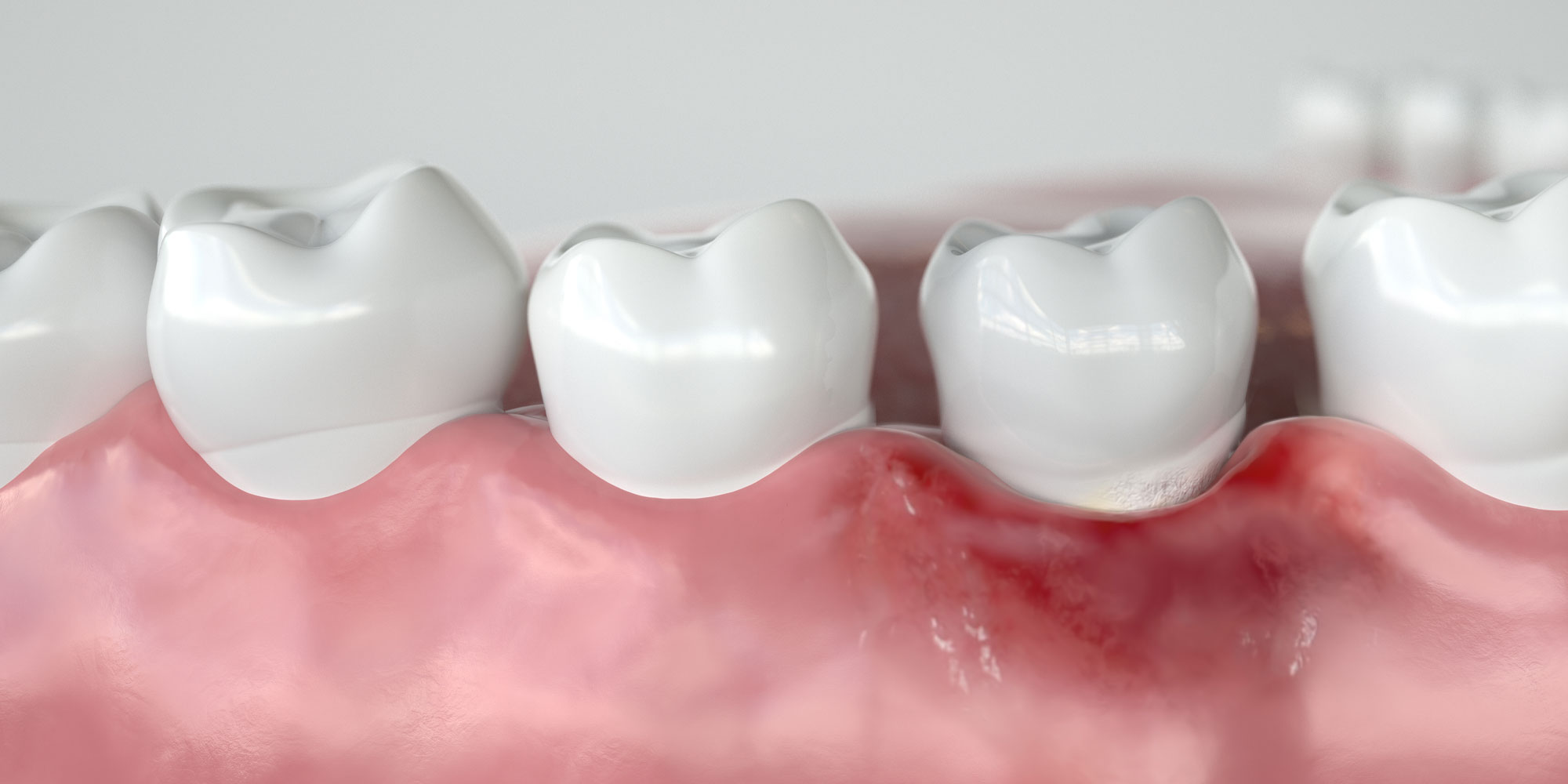 Pinhole Surgical Technique (PST)