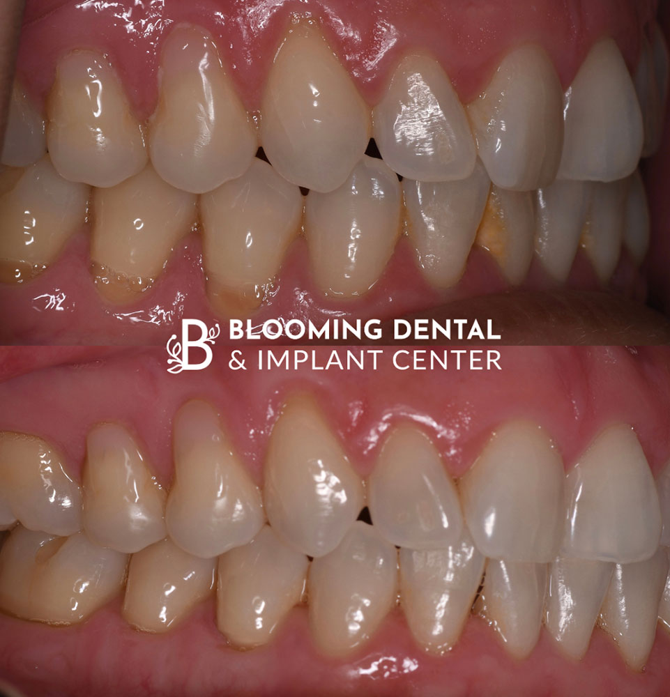 The Proof Is In Our Patients before after image teeth