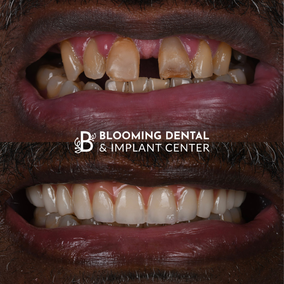 Full Mouth Dental Implant Image 111