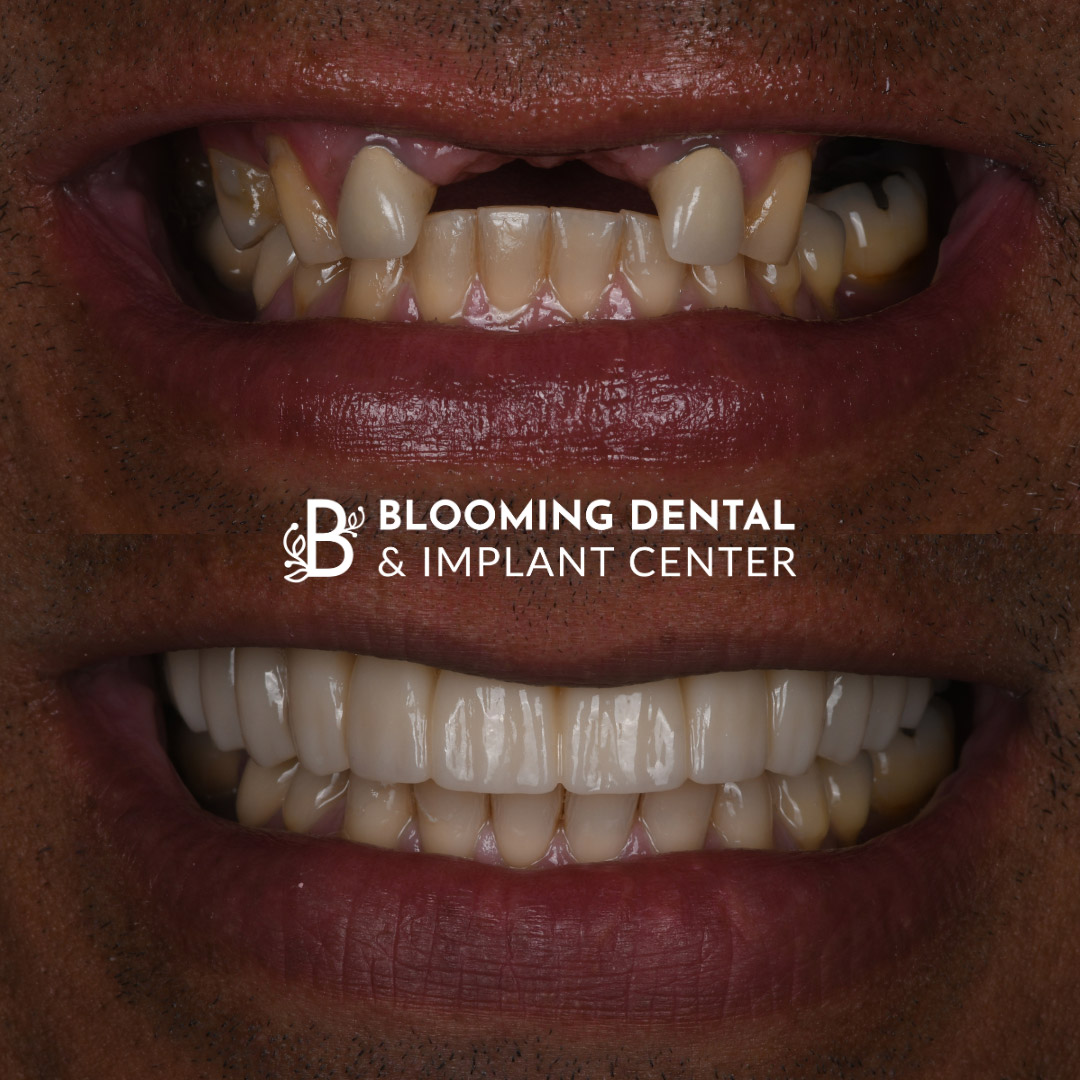 Full Mouth Dental Implant Image 114