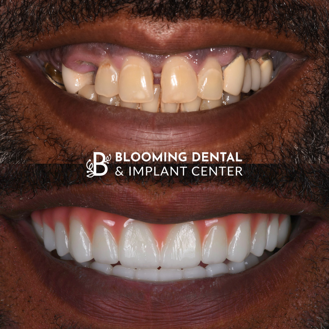 Full Mouth Dental Implant Image 79