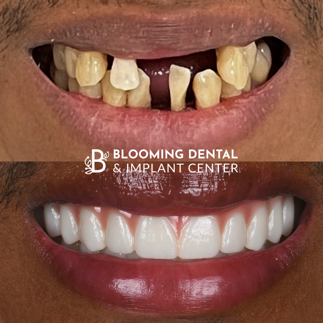 Full Mouth Dental Implant Image 85