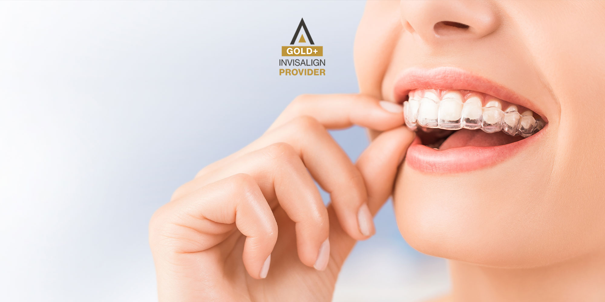 Invisalign Banner