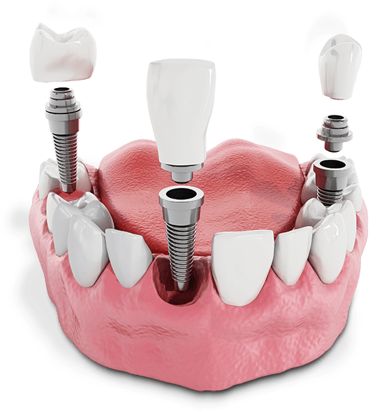 candidate for dental implants model