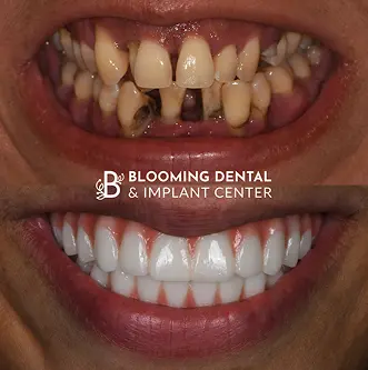 Before-After Image