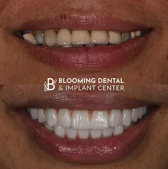 Before-After Image