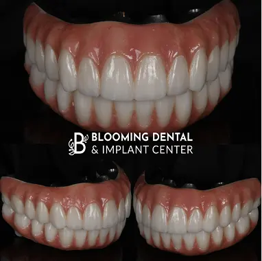 Titanium Bar & Zirconia Implant Bridge