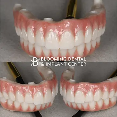 Zirconia Implant Bridge